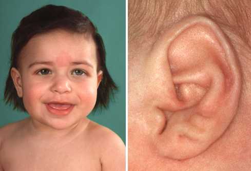 Beckwith-Wiedemann syndrome