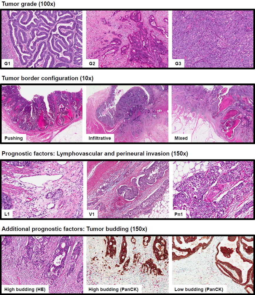 colon adenocarcinoma histology