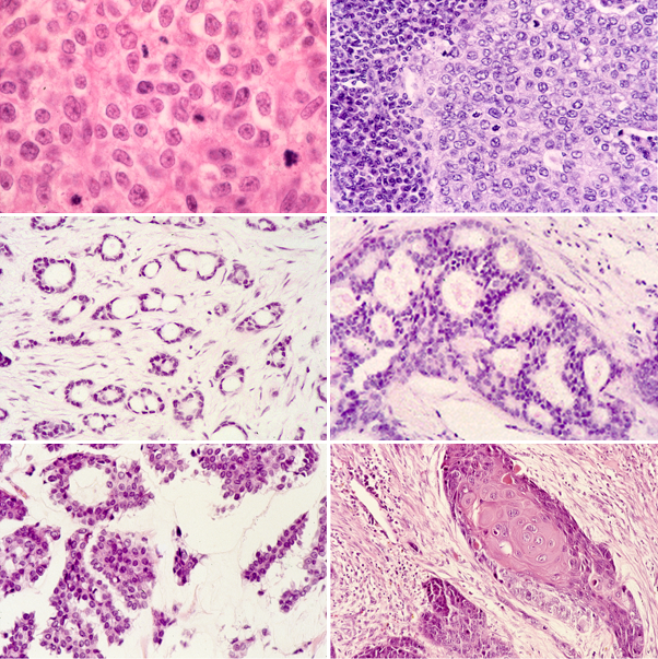 Breast: Ductal carcinoma